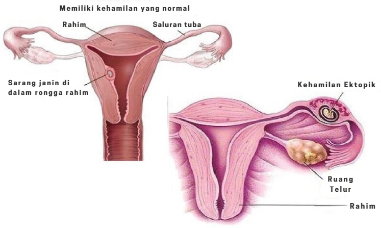 hamil 7 minggu sakit perut, sakit perut saat hamil muda, kehamilan 7 minggu , Bunda, si Kecil